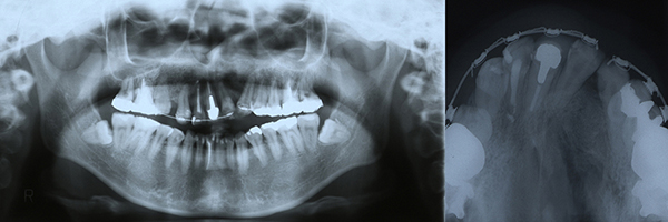 口唇口蓋裂の治療例　左側唇顎口蓋裂に起因する顔面非対称を呈する骨格性下顎前突　顎裂部骨移植４か月後　パントモ＋上顎咬合法Ｘ線写真